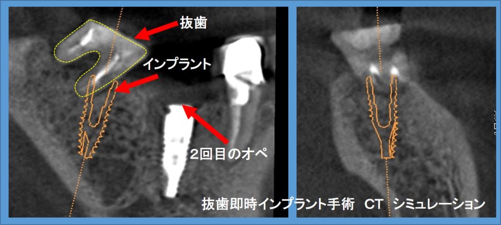 インプラント　右下奥歯　抜歯即時インプラント手術　ＣＴシミュレーションと術後ＣＴ画像①