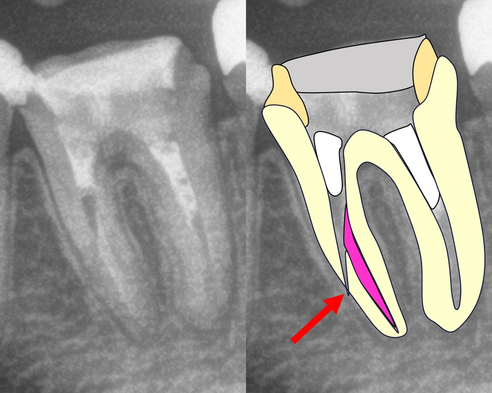 歯根に穴が開いている抜歯　根管治療　歯を残す方法　抜かない治療法