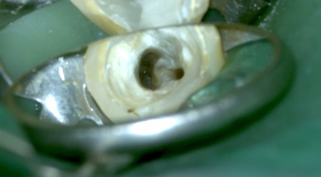 樋状根　根管治療　下顎第２大臼歯　