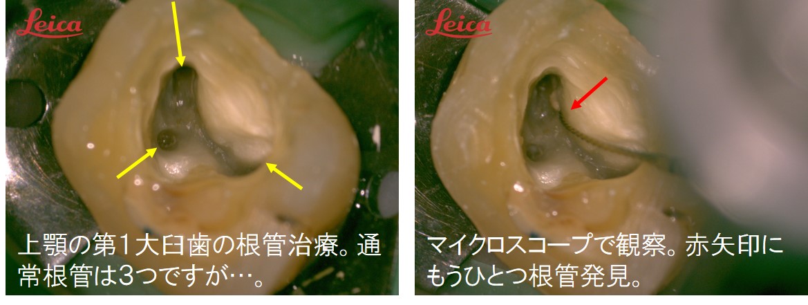 根管治療 MB2発現率は80％ 東京都内内幸町虎ノ門新橋霞ヶ関の歯医者歯科