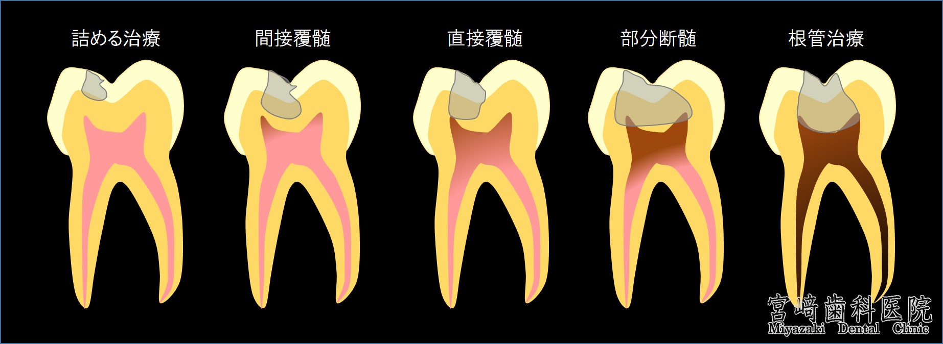 間接覆髄法　直接覆髄法　部分断髄法　根管治療　のむし歯の進行度合いを図で説明