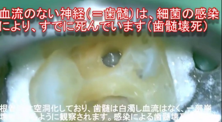 歯の神経を残せない症例　根管治療が必要な症例　歯髄　神経　画像　MTA　ドックベストセメント　3mix
