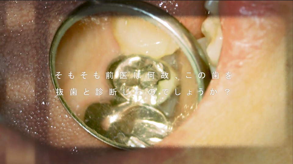 抜歯と診断された歯 画像 再根管治療 治る 治療法