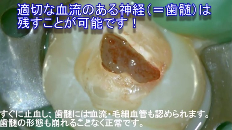 歯の神経を残せる症例　歯髄　神経　画像　MTA　ドックベストセメント　3mix