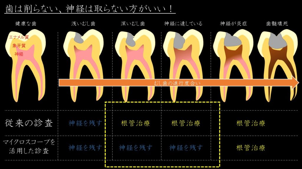 マイクロスコープ　歯の神経を残す治療　根管治療しない　出来るだけ残す　抜かない　その根拠　治療法　２