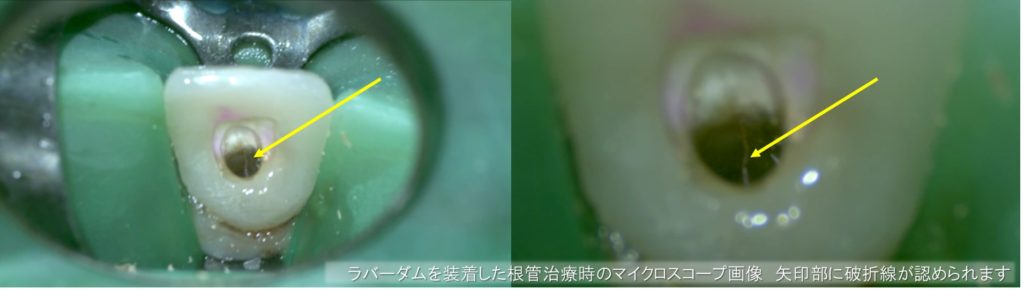 ラバーダム装着　根管治療時のマイクロスコープ画像　歯根破折の所見