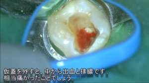 仮蓋を外すと中から排膿出血　根管治療した歯が痛い　痛みがひかない　再根管治療症例　下顎大臼歯奥歯