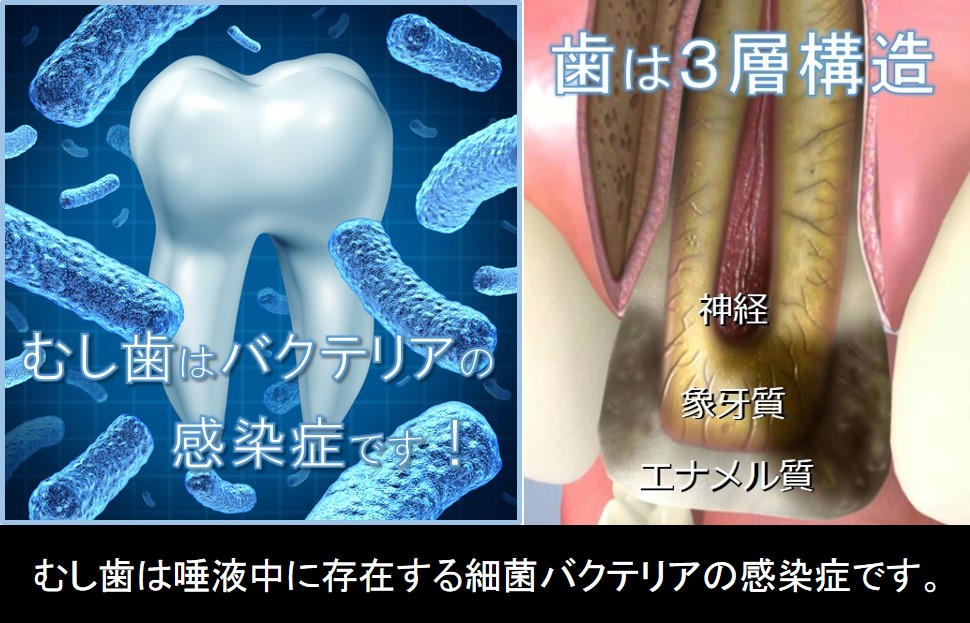 むし歯は唾液中に存在する細菌の感染症です