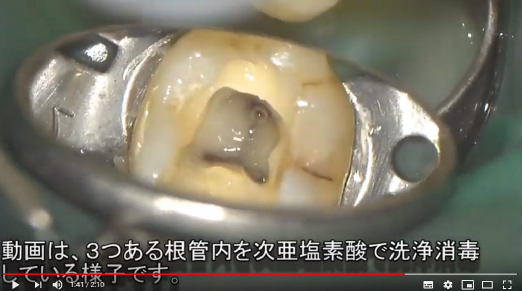 深いむし歯　ラバーダムを装着　マイクロスコープ根管治療　不可逆性の歯髄炎　根管内の洗浄消毒　次亜塩素酸洗浄