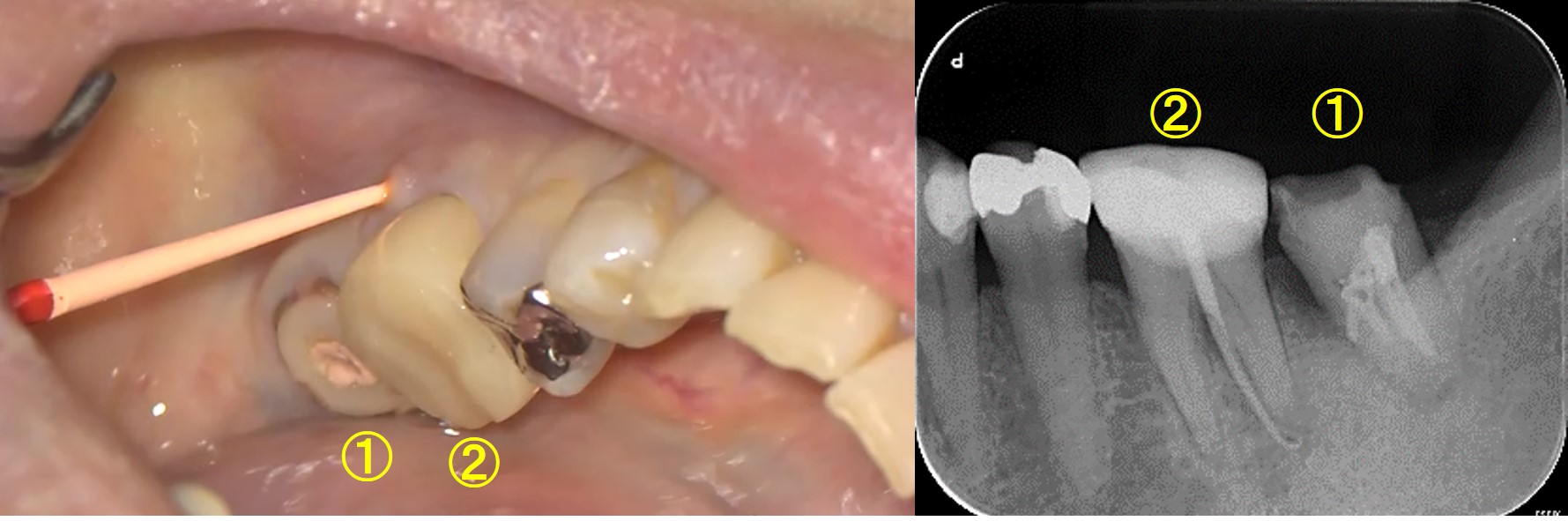 奥歯 の 奥 腫れ