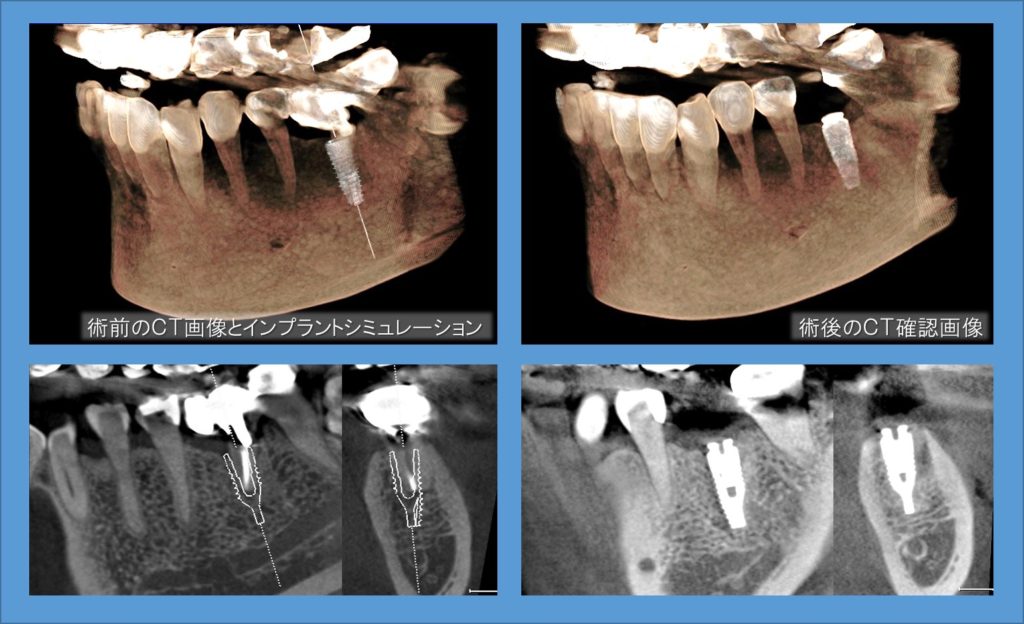 インプラント　初診時　口内写真　レントゲン画像　下顎大臼歯　カンチレバーﾌﾞﾘｯｼﾞブリッジの支え　ｃｔシミュレーション